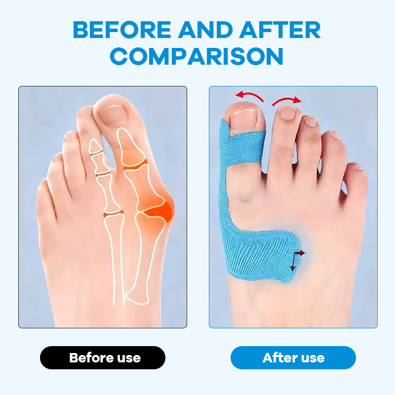Geef Je Voeten De Zorg Die Ze Verdienen! 丨 Voorgesneden kinesiologietape voor hallux valgus🦶💙✨