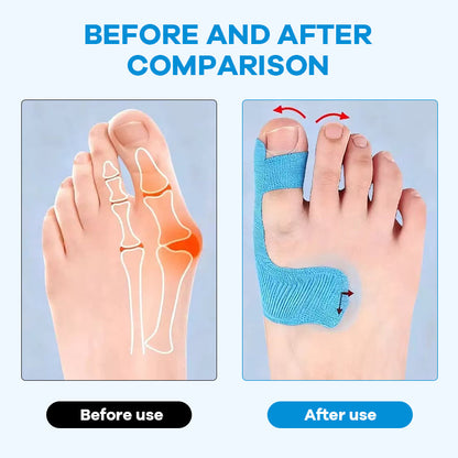 Geef Je Voeten De Zorg Die Ze Verdienen! 丨 Voorgesneden kinesiologietape voor hallux valgus🦶💙✨